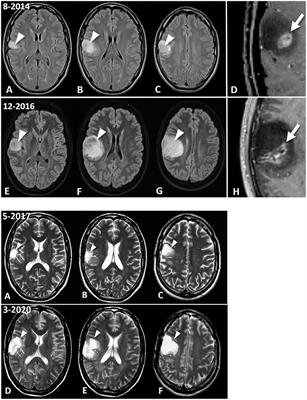 Ketogenic Metabolic Therapy, Without Chemo or Radiation, for the Long-Term Management of IDH1-Mutant Glioblastoma: An 80-Month Follow-Up Case Report